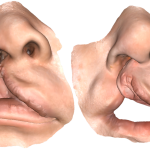 Dove la cura incontra la tecnologia nasce il primo sorriso di un bambino