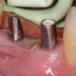 Estrazione di radice e preservazione alveolare con metodica chirurgica “Fill & Seal”