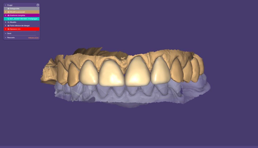 riabilitazione impianti con faccette