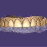Riabilitazione combinata con impianti e faccette seguendo un flusso interamente digitale riabilitazione impianti con faccette