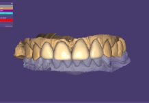 Riabilitazione combinata con impianti e faccette seguendo un flusso interamente digitale riabilitazione impianti con faccette
