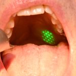 Il laser nel trattamento del russamento Laser russamento OSAS