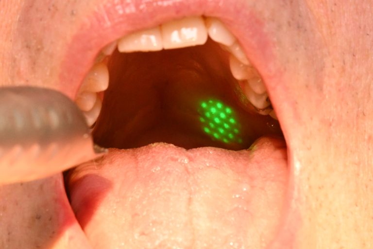 Il laser nel trattamento del russamento