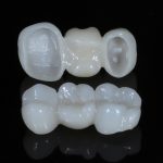 Cementi di fissaggio e corone in zirconia allo studio zirconia