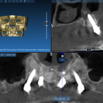 Impianti zigomatici come rescue implants nei fallimenti implantari impianti zigomatici