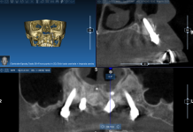 Impianti zigomatici come rescue implants nei fallimenti implantari impianti zigomatici