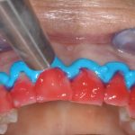 Il laser nello sbiancamento dentale professionale
