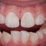 Restauro estetico indiretto di un incisivo centrale traumatizzato in paziente pediatrico rESTAURO ESTETICO INDIRETTO