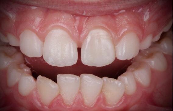 rESTAURO ESTETICO INDIRETTO