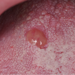 Trattamento del granuloma piogenico con laser a diodi Granuloma piogenico