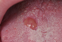 Trattamento del granuloma piogenico con laser a diodi Granuloma piogenico