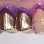 Il minimo intervento nella gestione domiciliare della lesione cariosa nel paziente anziano