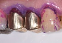 Il minimo intervento nella gestione domiciliare della lesione cariosa nel paziente anziano