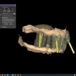 Chirurgia guidata con scansione facciale e impianti one-piece Chirurgia guidata