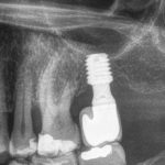 Riabilitazione di secondo molare mascellare con impianto corto, rialzo di seno transcrestale e innesto autologo. Serie di casi con analisi retrospettiva impianto corto