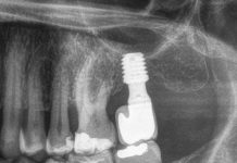 Riabilitazione di secondo molare mascellare con impianto corto, rialzo di seno transcrestale e innesto autologo. Serie di casi con analisi retrospettiva impianto corto