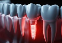 Impianti dentali, come scongiurarne il rischio di fallimento fallimento implantare