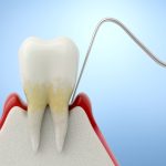 Malattia parodontale tra vecchie e nuove correlazioni Malattia parodontale