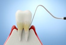 Malattia parodontale tra vecchie e nuove correlazioni Malattia parodontale