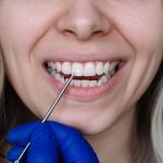 Remineralizzazione dello smalto con ultrasuoni focalizzati e cluster ionici remineralizzazione smalto