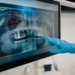 Densità ossea relativa, come misurarla con un software open source Densità ossea relativa