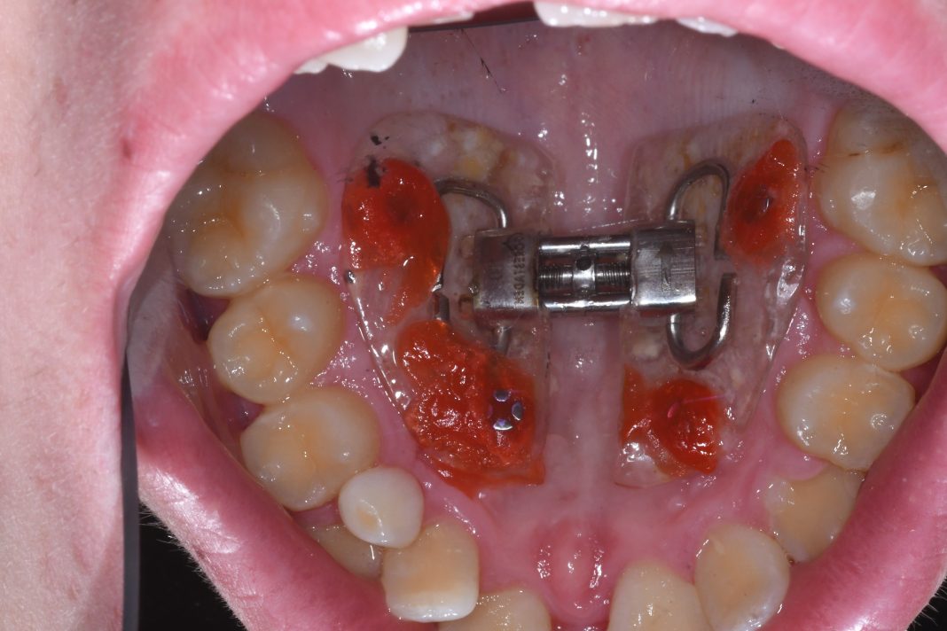 Disgiuntore palatale C-Expander