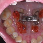 Disgiunzione palatale con C-Expander in pazienti tardo-adolescenziali Disgiuntore palatale C-Expander