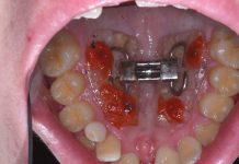 Disgiunzione palatale con C-Expander in pazienti tardo-adolescenziali Disgiuntore palatale C-Expander