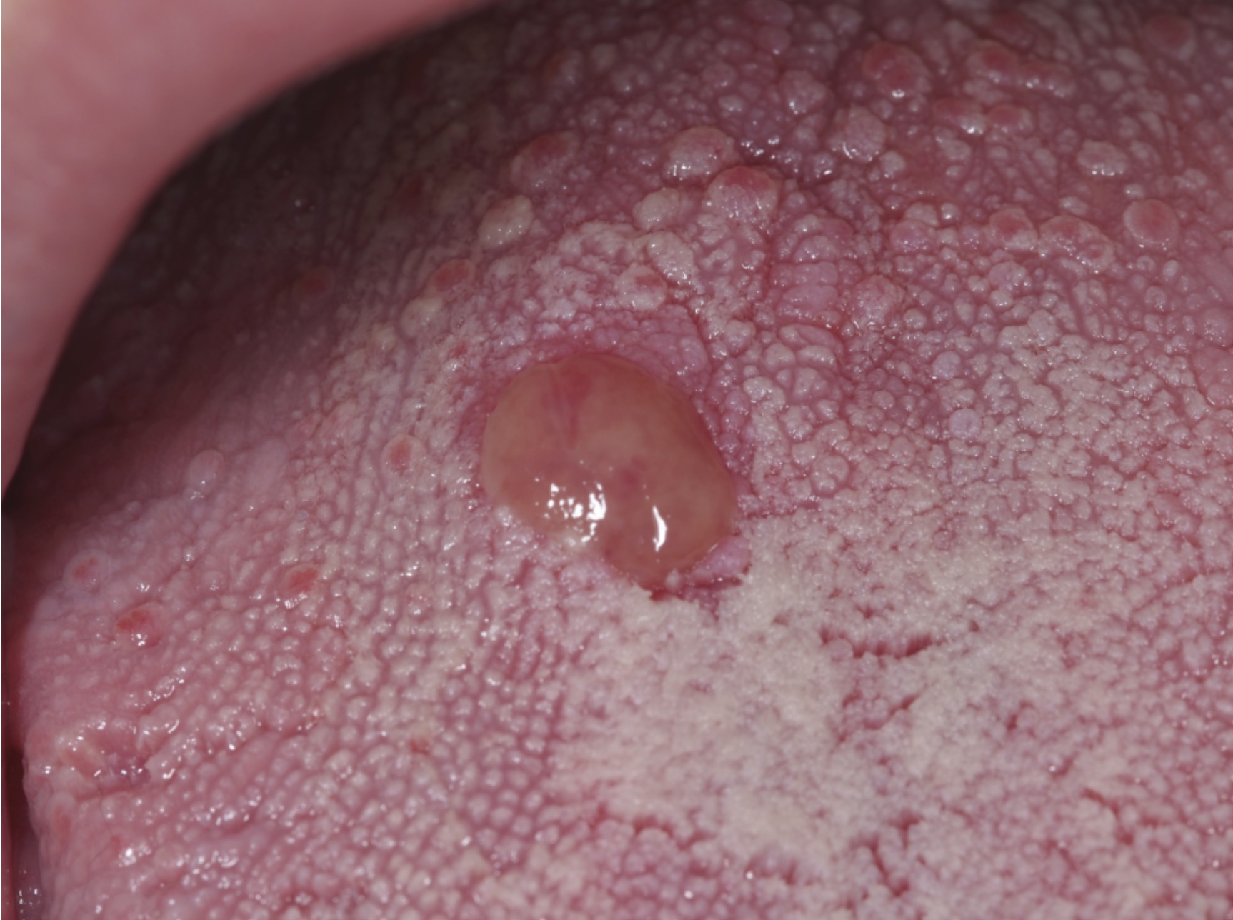 Trattamento del granuloma piogenico con laser a diodi