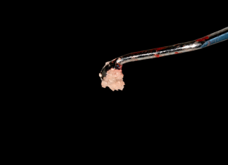 Il dente come materiale da innesto. Un caso clinico