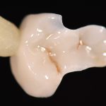 Restauri indiretti in composito fresato nel workflow digitale