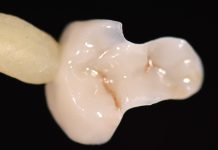 Restauri indiretti in composito fresato nel workflow digitale