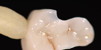 Restauri indiretti in composito fresato nel workflow digitale