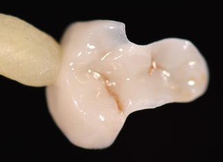 Restauri indiretti in composito fresato nel workflow digitale Restauri indiretti