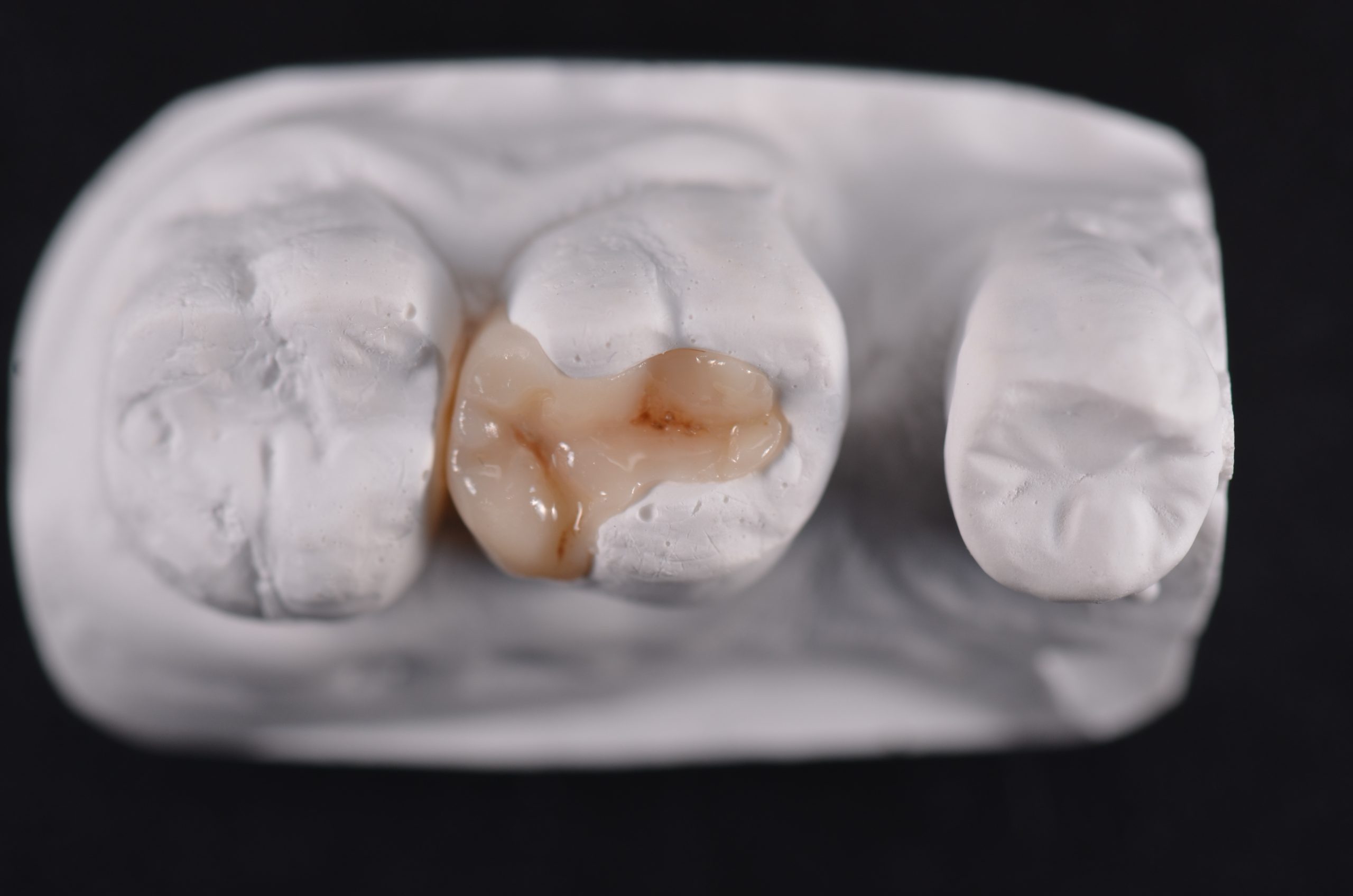 Restauri indiretti composito fresato