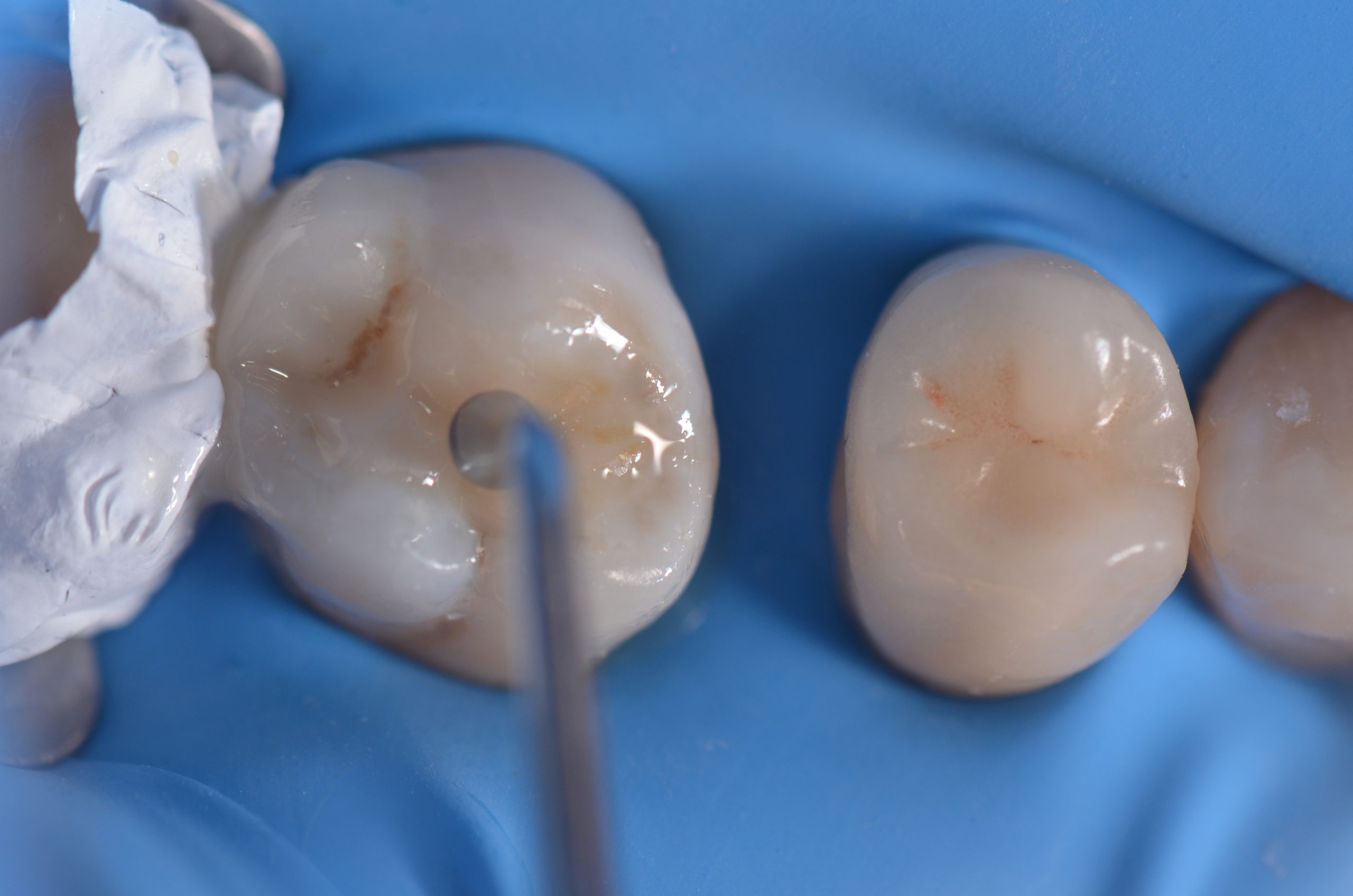 Restauri indiretti composito fresato