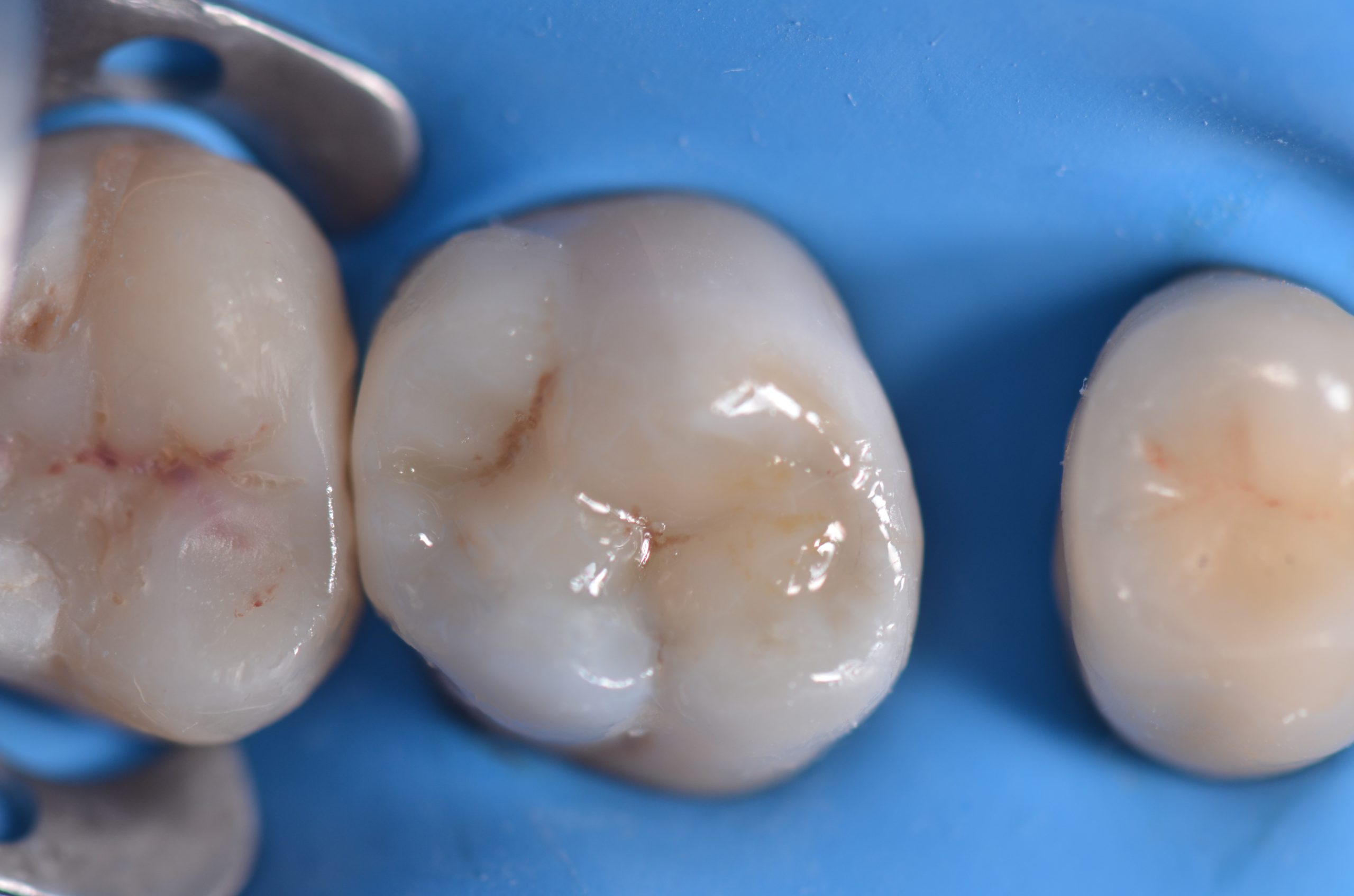 Restauri indiretti composito fresato