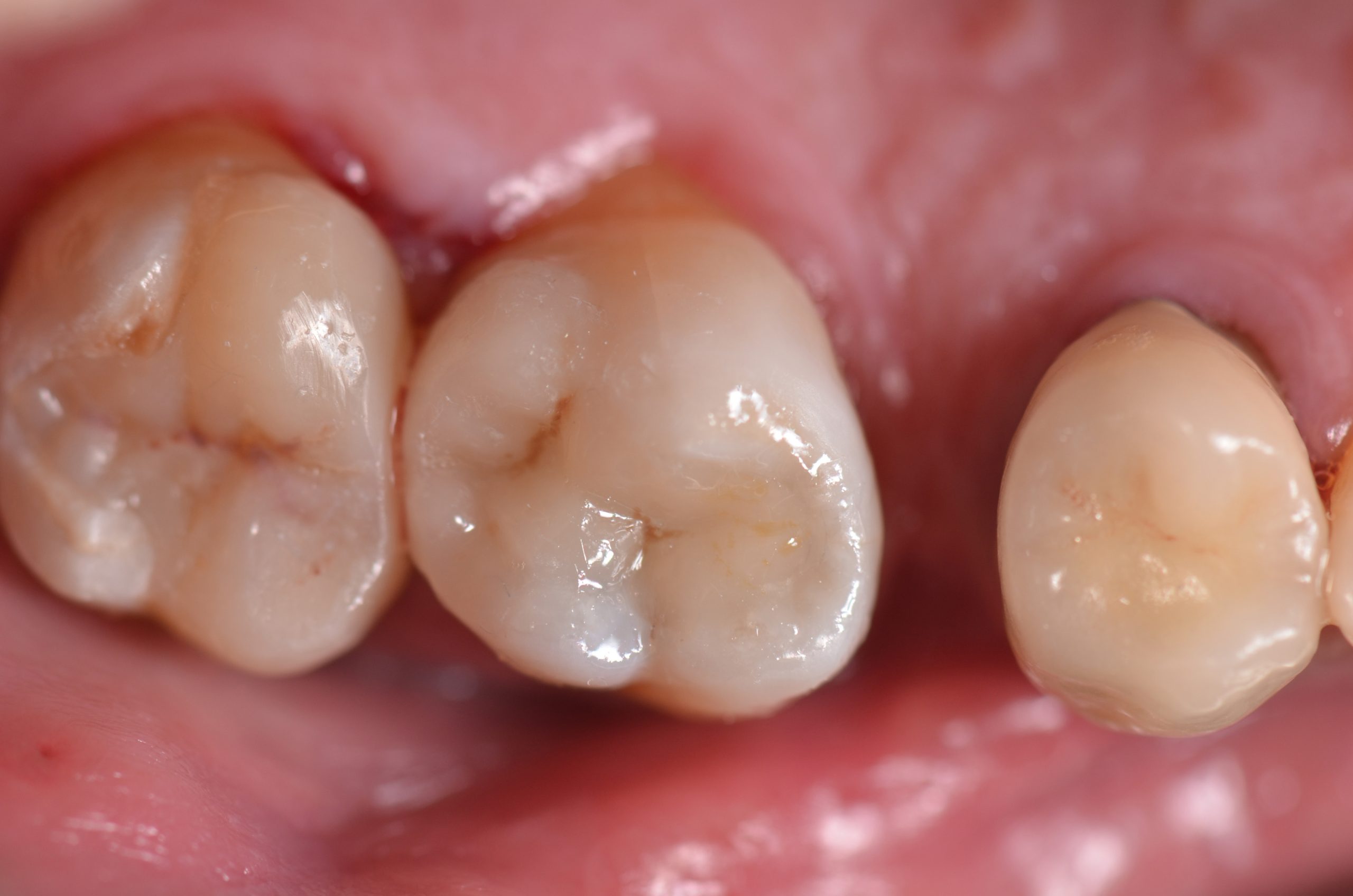 restauri indiretti composito fresato