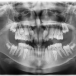 Mixoma odontogeno del mascellare in età pediatrica: caso clinico mixoma odontogeno