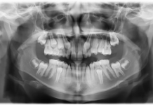 Mixoma odontogeno del mascellare in età pediatrica: caso clinico mixoma odontogeno