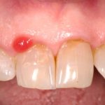 Epulidi gengivali in aree ad alta valenza estetica. Trattamento chirurgico mini-invasivo Epulidi gengivali