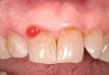 Epulidi gengivali in aree ad alta valenza estetica. Trattamento chirurgico mini-invasivo Epulidi gengivali