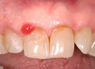 Epulidi gengivali in aree ad alta valenza estetica. Trattamento chirurgico mini-invasivo Epulidi gengivali