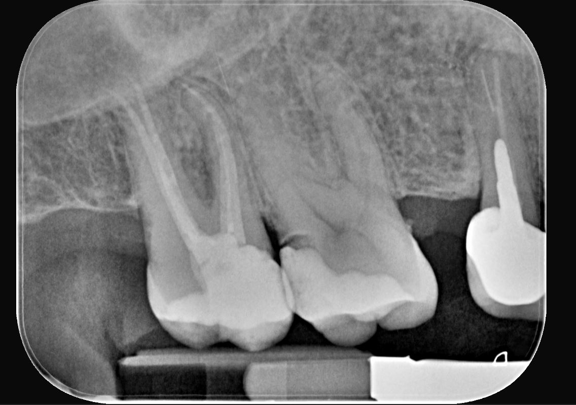 Restauri indiretti composito fresato