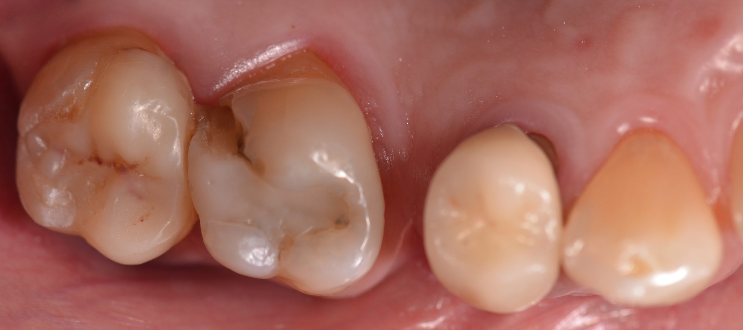 Restauri indiretti composito fresato