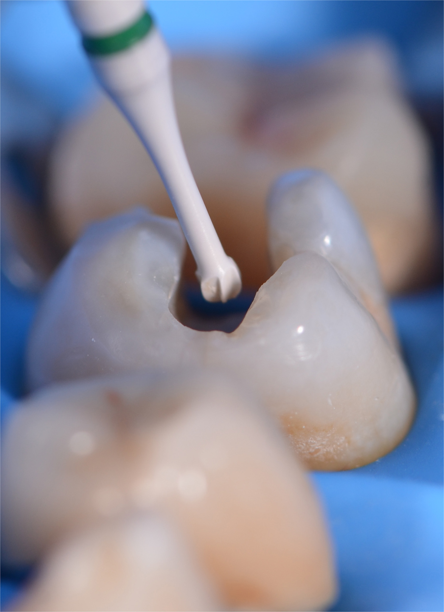 Restauri indiretti composito fresato