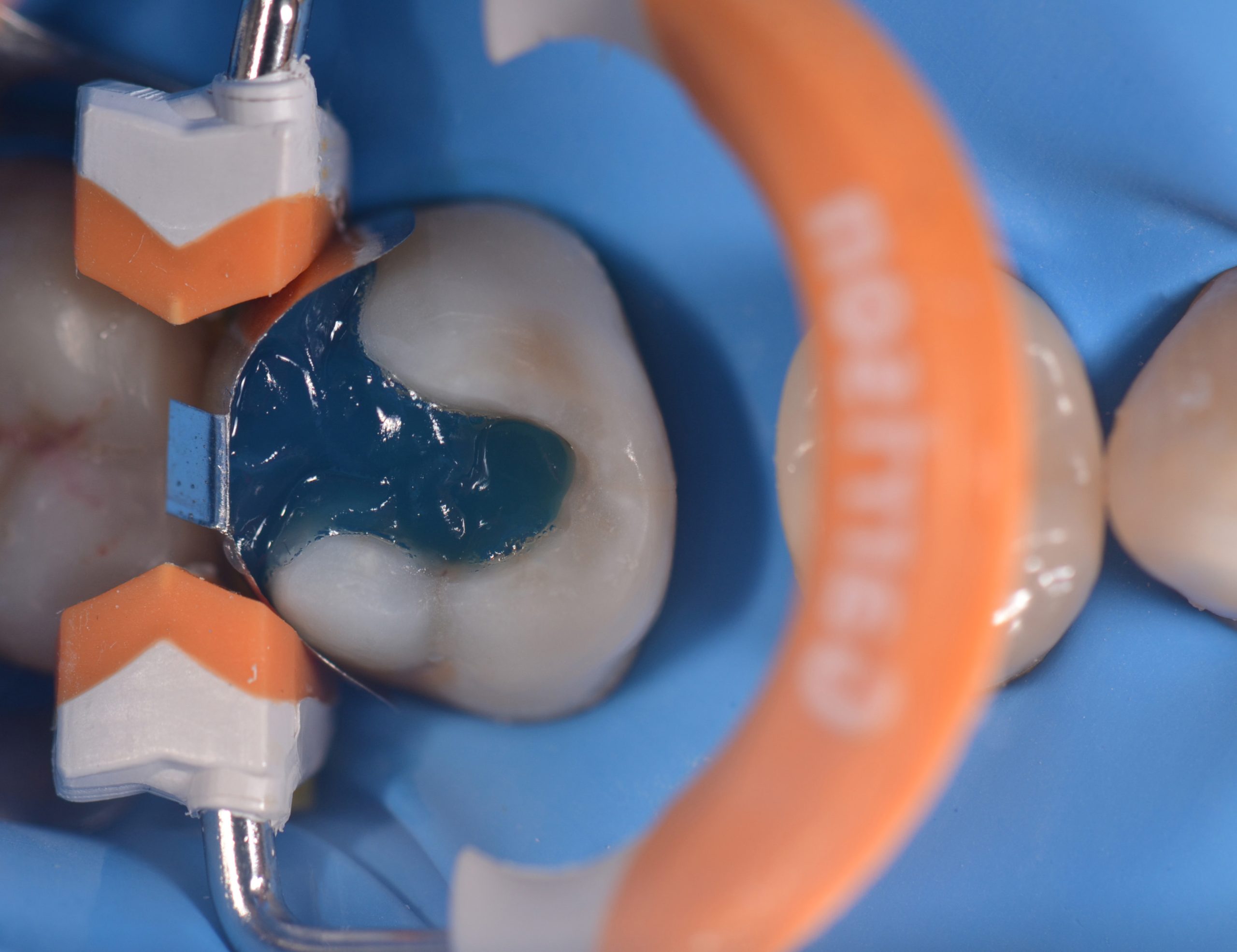 Restauri indiretti composito fresato