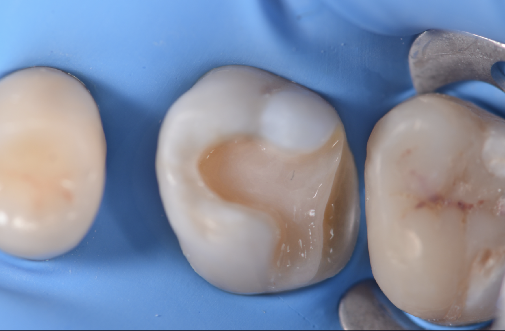 Restauri indiretti composito fresato