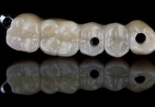 La zirconia stampata in 3D: nuove frontiere per la protesi odontoiatrica Zirconia stampa 3D