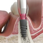 Perdita ossea perimplantare: ecco i parametri da considerare perdita ossea perimplantare